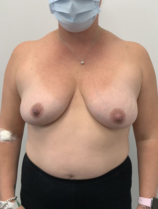Breast Augmentation case #1227