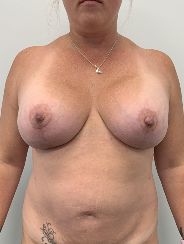 Breast Augmentation case #1227