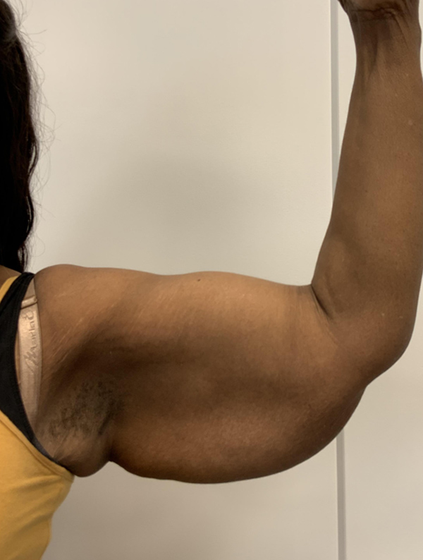 arm lift before and after | New You Plastic Surgery in New York