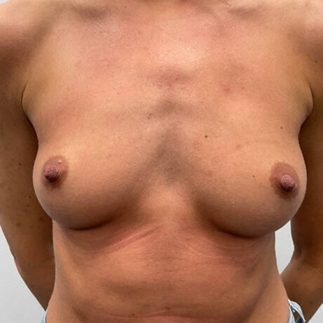 Breast Augmentation case #1944
