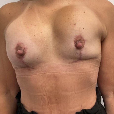Breast Implant Revision case #1956