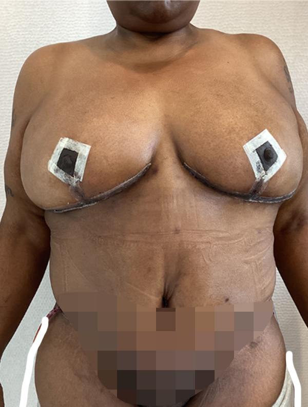Breast Reduction and Lift case #1976
