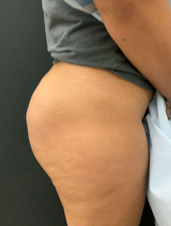 brazilian butt lift results | New You Plastic Surgery in New York