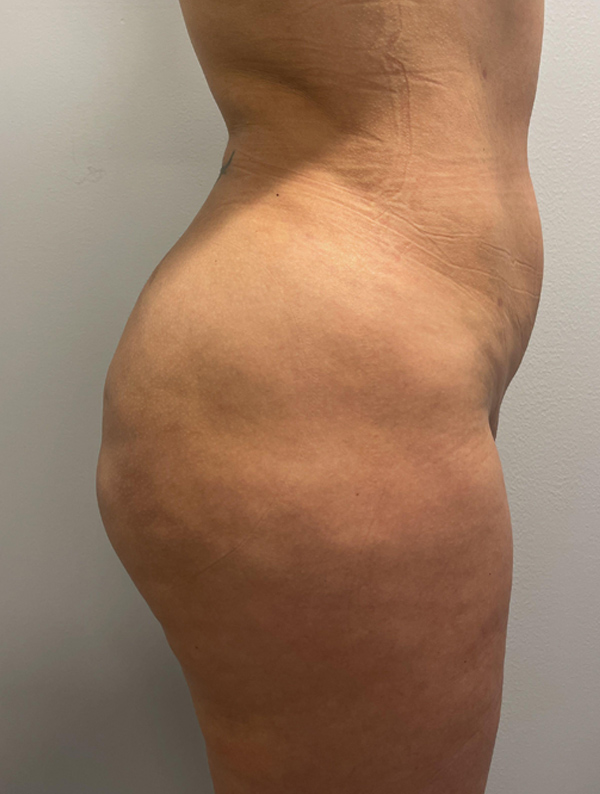 brazilian butt lift results | New You Plastic Surgery in New York