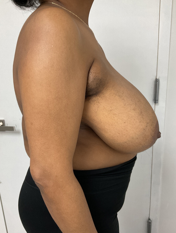 Breast Reduction and Lift case #1971