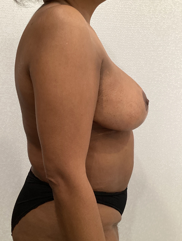 Breast Reduction and Lift case #1971
