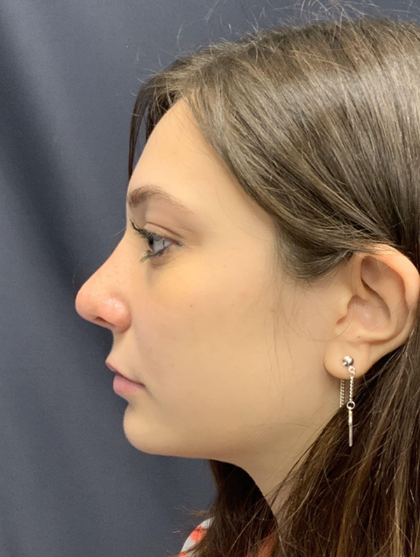 Rhinoplasty case #2089