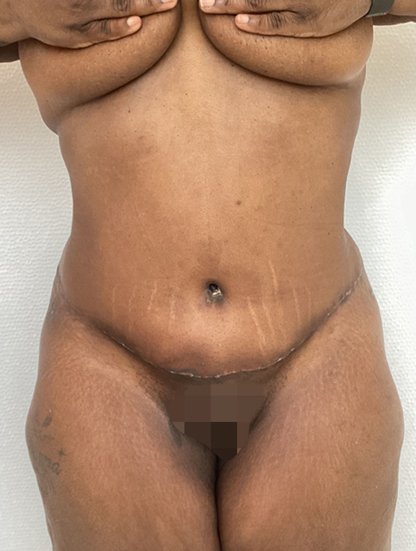 tummy tuck results | New You Plastic Surgery in New York