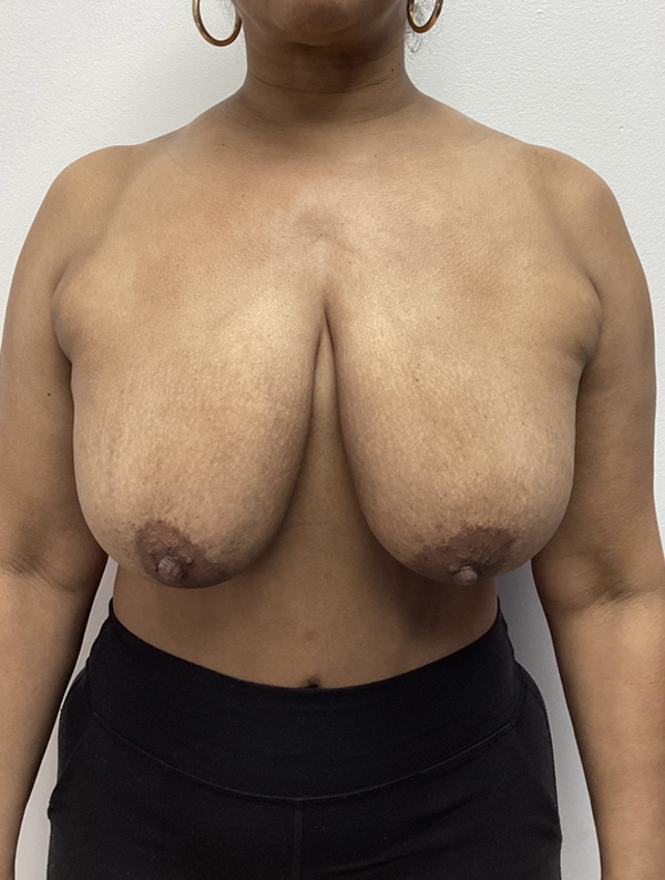 Breast Reduction and Lift case #1983
