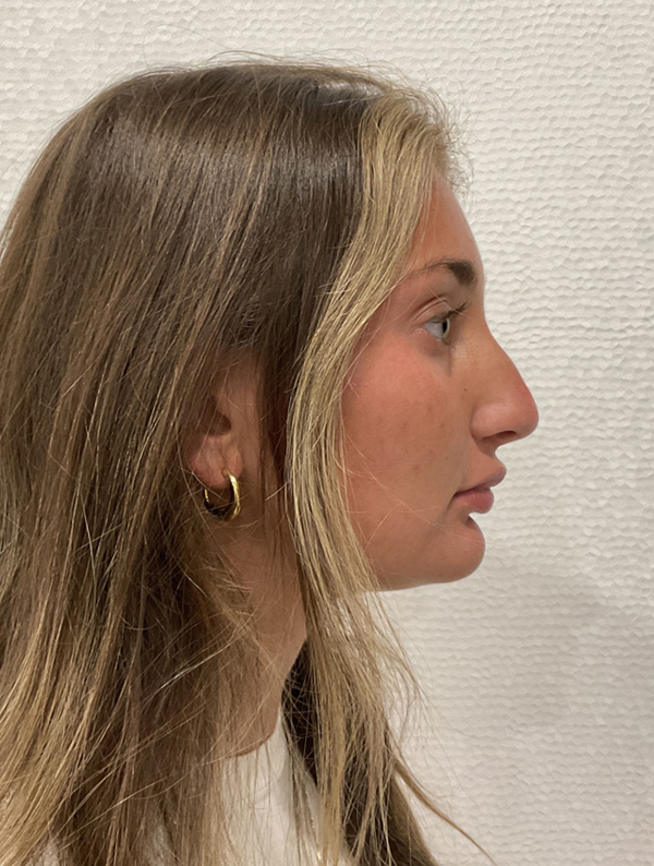 rhinoplasty before and after results | New You Plastic Surgery in New York