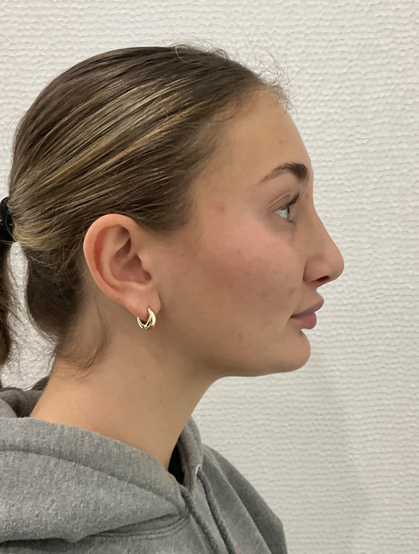 rhinoplasty before and after results | New You Plastic Surgery in New York