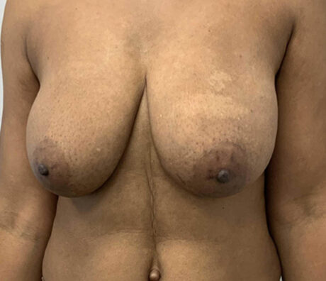 Breast Reduction case #1986