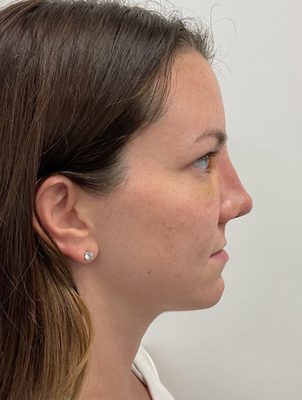 Rhinoplasty case #2079