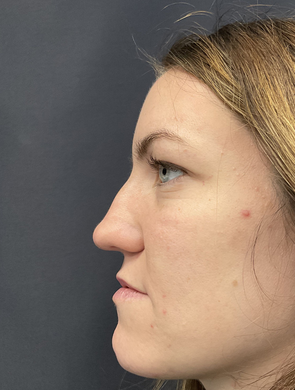 Rhinoplasty case #2079