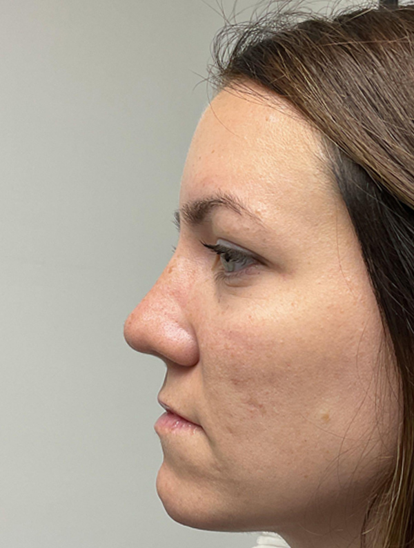 Rhinoplasty case #2079