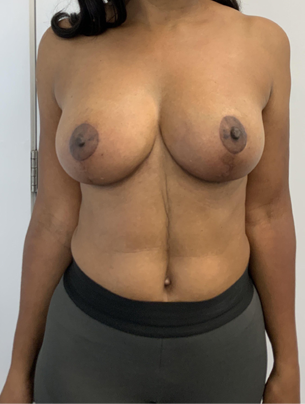 Breast Reduction and Lift case #1986