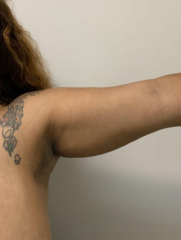 Liposuction case #5674