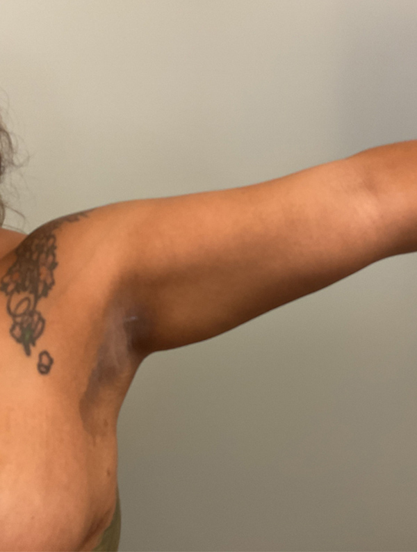 Liposuction case #5674