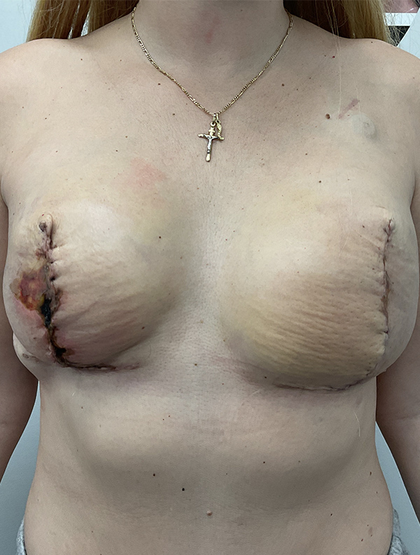 breast reconstruction before and after results | New You Plastic Surgery in New York