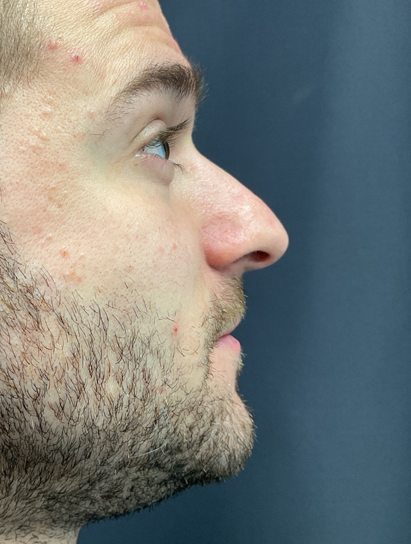 male rhinoplasty before and after results | New You Plastic Surgery in New York