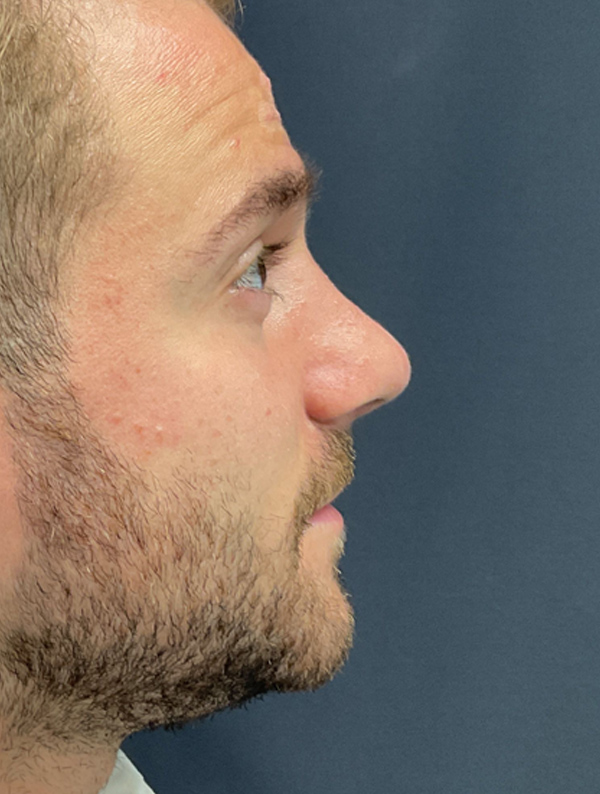 male rhinoplasty before and after results | New You Plastic Surgery in New York