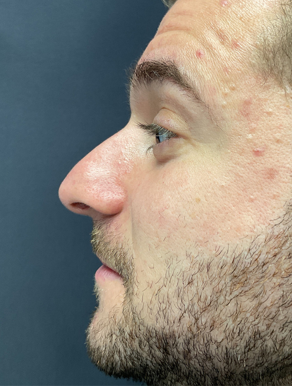 male rhinoplasty before and after results | New You Plastic Surgery in New York