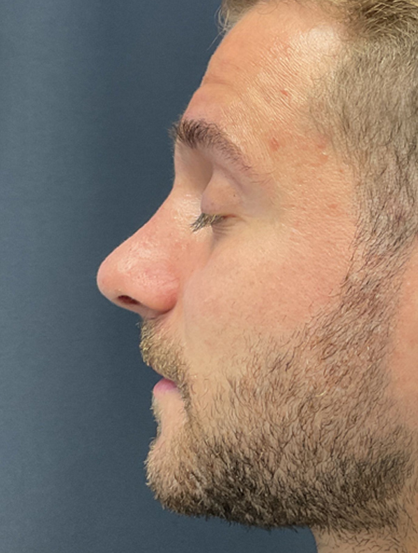 male rhinoplasty before and after results | New You Plastic Surgery in New York