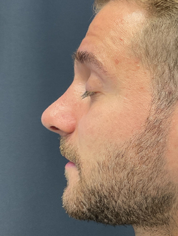 Rhinoplasty case #2094