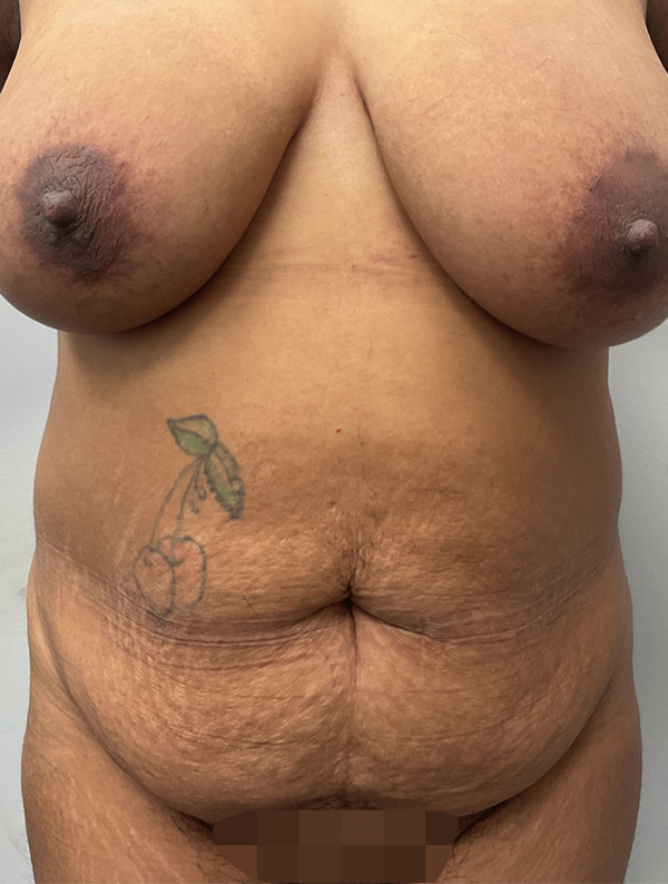 tummy tuck before and after results | New You Plastic Surgery in New York