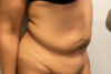 Tummy Tuck case #2140