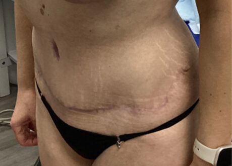 Tummy Tuck case #2135
