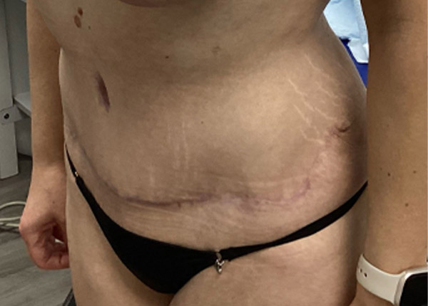 Tummy Tuck case #2135