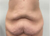 Tummy Tuck case #2135