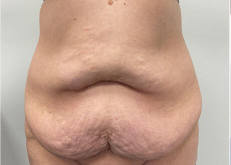Tummy Tuck case #2135