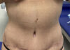Tummy Tuck case #2135