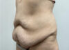Tummy Tuck case #2135