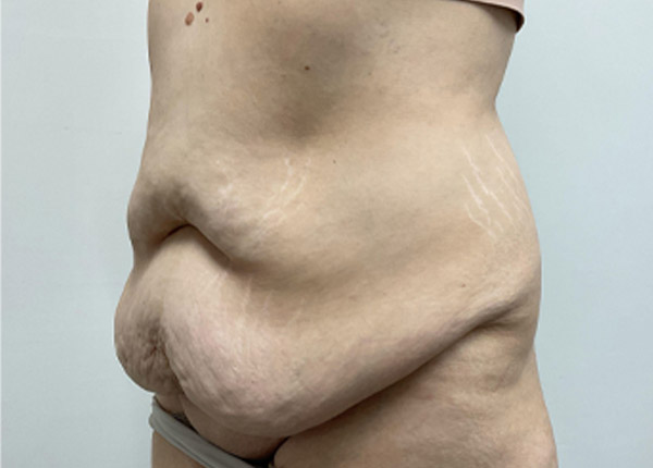 Tummy Tuck case #2135