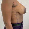 Breast Implant Revision case #3902