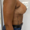 Breast Implant Revision case #3902
