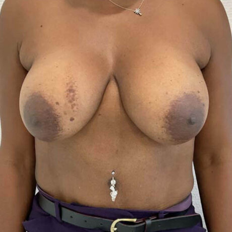 Breast Implant Revision case #3902