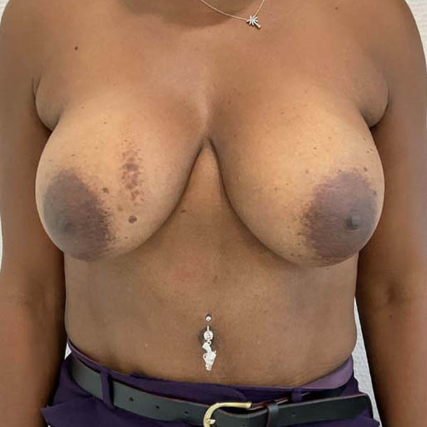 Breast Implant Revision case #3902