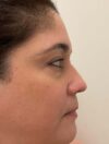 Rhinoplasty case #3950