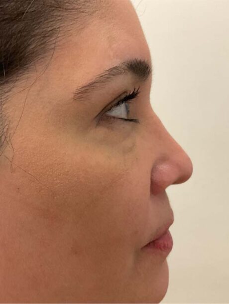 Rhinoplasty case #3950