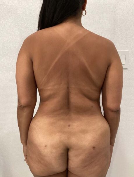 Liposuction case #3914