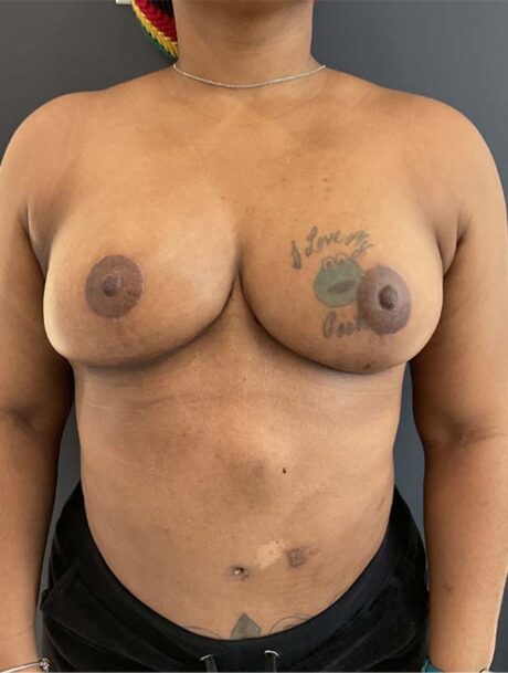 Breast Reduction and Lift case #3877