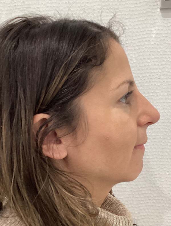 Rhinoplasty case #3934