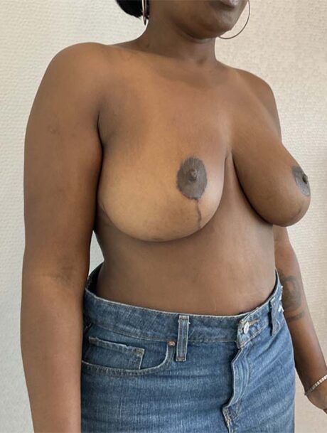 Breast Reduction and Lift case #3884
