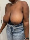 Breast Reduction and Lift case #3884