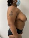 Breast Reduction and Lift case #3877