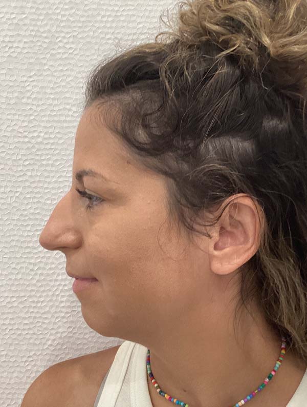 Rhinoplasty case #3934